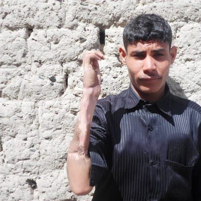 جرحى الثورة يعودون من الهند بدون علاج والجريح الحكمي يكشف عن المعاناة التي تعرضوا وكيف تعاملت معهم السفارة اليمنية 1 12 04 13 210169656