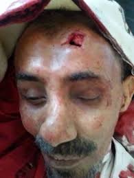 ناشطون ينشرون صورة للمحطوري بعد استشهاده 1 المحطوري بعد مقتله