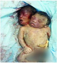 امرأة يمنية تلد ثلاثة إناث واثنين ذكور بصنعاء